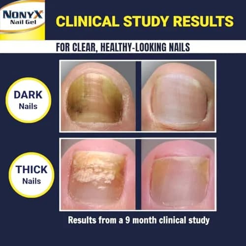 NONYX Fungal Nail Clarifying Gel 118ml (4 Fl Oz) | Clinically Proven to Improve Nail Appearance thumbnail 4