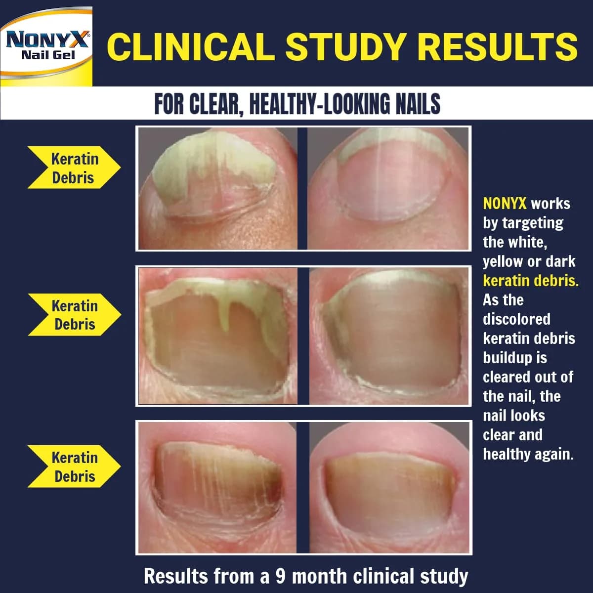 NONYX Fungal Nail Clarifying Gel 118ml (4 Fl Oz) | Clinically Proven to Improve Nail Appearance - view 3
