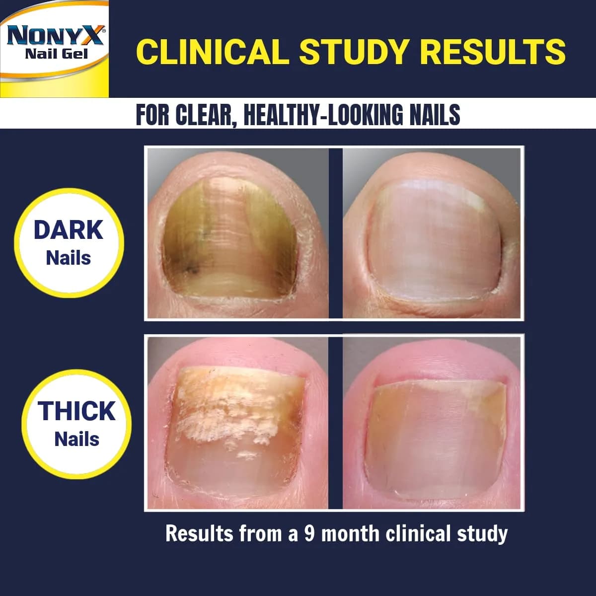 NONYX Fungal Nail Clarifying Gel 118ml (4 Fl Oz) | Clinically Proven to Improve Nail Appearance - view 4