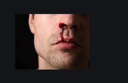 NasalCEASE FirstAid Nosebleeds | Natural Clotting Aid for All Ages in India thumbnail 4