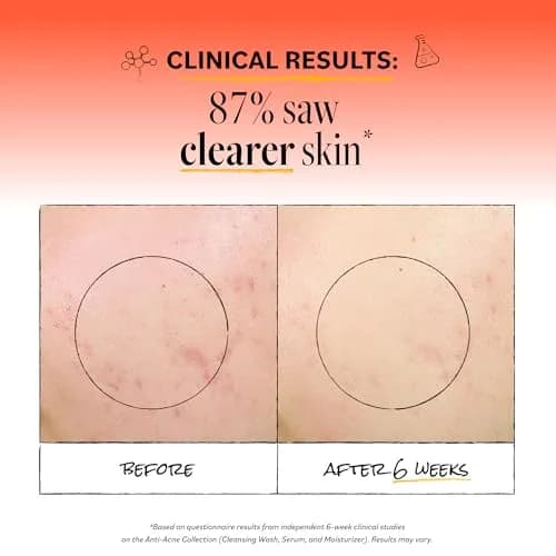 Derma E Acne Deep Pore Cleansing Face Wash 177ml (6 Fl Oz) | Gentle Oil Control for Breakout-Prone Skin thumbnail 3