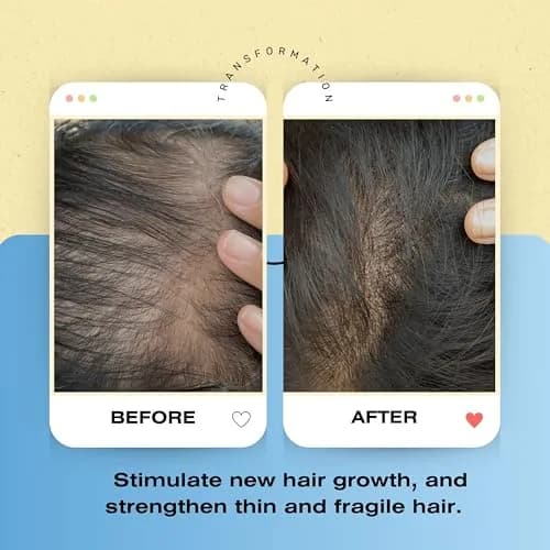 Mediceuticals Bioclenz Shampoo 250ml (8.45 Fl Oz) | Anti-Hair Loss Formula for Men & Women thumbnail 5