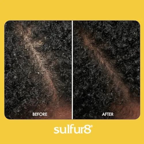 SULFUR8 Kids Anti-Dandruff Shampoo 220ml (7.5 Fl Oz) | Medicated Dandruff Control for Itchy Scalp thumbnail 6