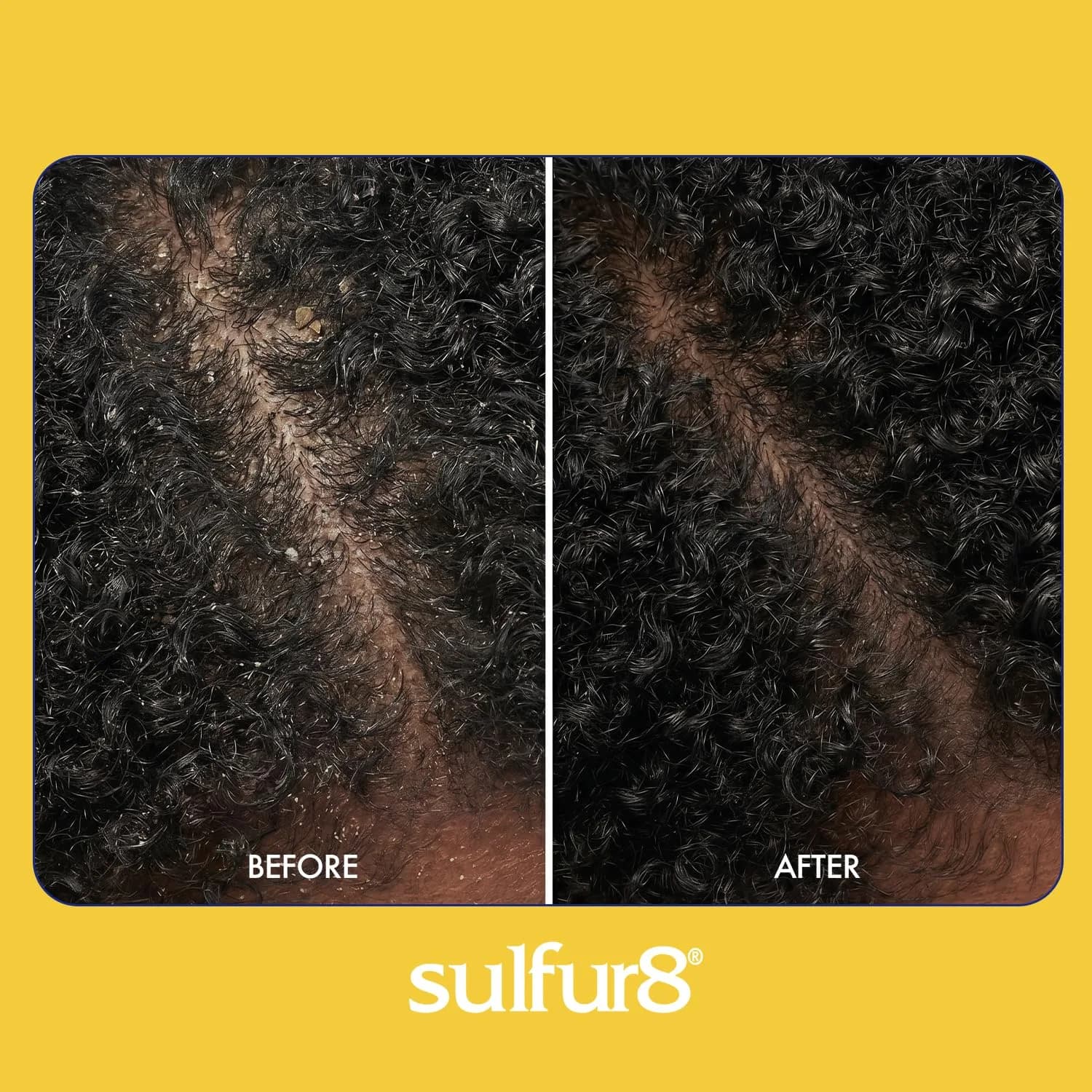 SULFUR8 Kids Anti-Dandruff Shampoo 220ml (7.5 Fl Oz) | Medicated Dandruff Control for Itchy Scalp - view 6