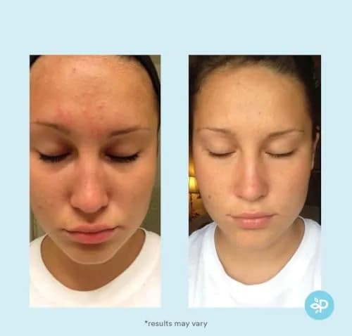 Perfect Image Glycolic Acid 30% Gel Peel with Retinol & Green Tea, 30mL | Professional Chemical Exfoliant for All Skin Types thumbnail 4