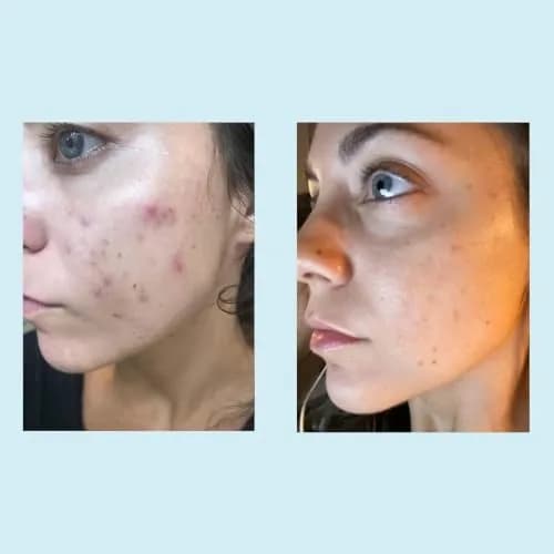 Perfect Image Glycolic Acid 30% Gel Peel with Retinol & Green Tea, 30mL | Professional Chemical Exfoliant for All Skin Types thumbnail 5