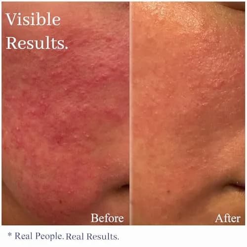 Hey Honey Relax Rosacea Relief Cream 71ml (2.4 Oz) | Calming Face Moisturizer for Redness & Irritation thumbnail 2