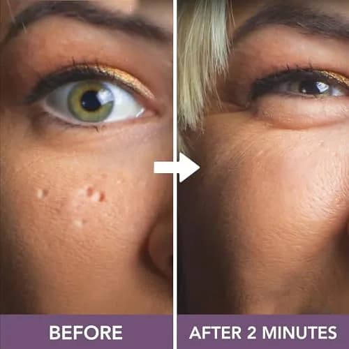 Dermaflage Scar Filler Kit Bronze Medium Waterproof Concealer for Acne Scars Wrinkles Ice Pick Scars Makeup | 1 mo supply thumbnail 7