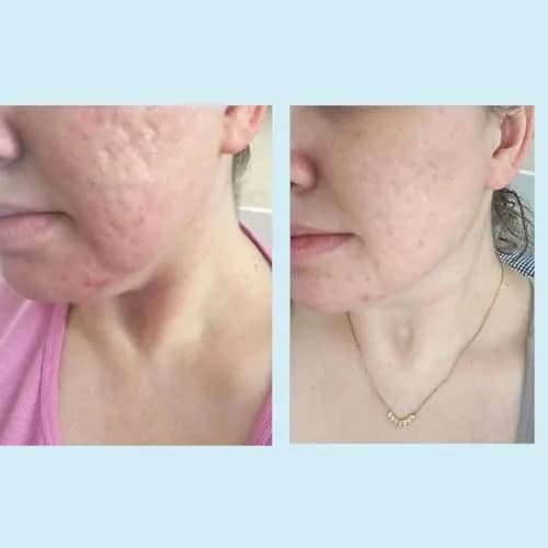 Perfect Image Glycolic Acid 50% Gel Peel with Retinol & Green Tea, 30ml | Professional Skin Exfoliant for Dry Skin thumbnail 4