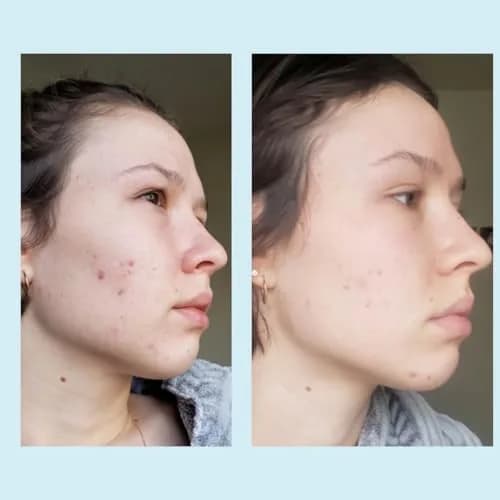 Perfect Image Glycolic Acid 50% Gel Peel with Retinol & Green Tea, 30ml | Professional Skin Exfoliant for Dry Skin thumbnail 6