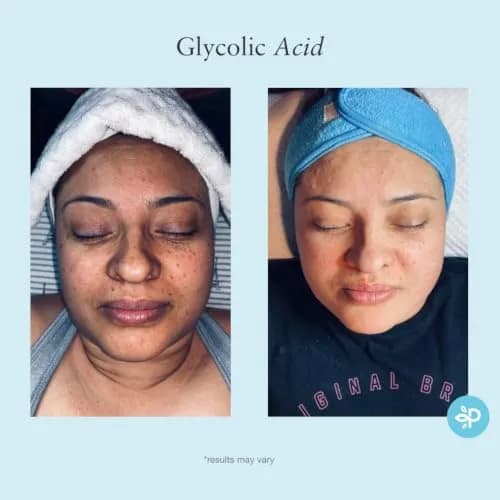 Perfect Image Glycolic Acid 50% Gel Peel with Retinol & Green Tea, 30ml | Professional Skin Exfoliant for Dry Skin thumbnail 7