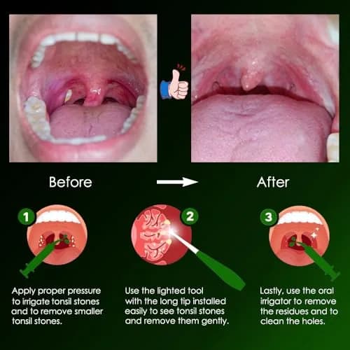 airgoesin Upgraded Tonsil Stone Remover Tool with 5 Tips & Irrigator | Fresh Breath Oral Rinse thumbnail 6