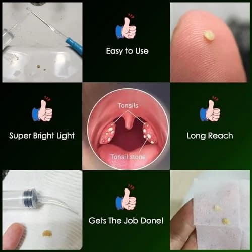 airgoesin Upgraded Tonsil Stone Remover Tool with 5 Tips & Irrigator | Fresh Breath Oral Rinse thumbnail 7