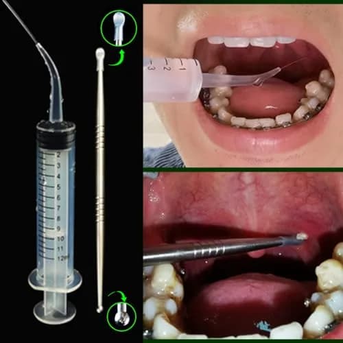 Airgoesin Tonsil Stone Remover LED Tool Kit 2 Sets | Painless Removal for Fresher Breath thumbnail 4
