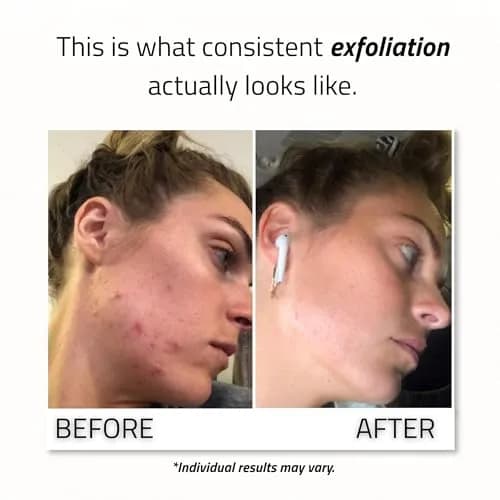 YEOUTH Glycolic Acid Face Peel 30% with Retinol & Green Tea 1oz | Brightening & Exfoliating thumbnail 4