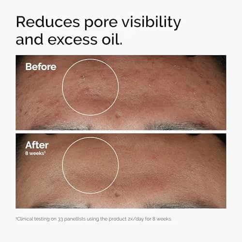 The Ordinary Niacinamide 10% + Zinc 1% Serum for Blemish-Prone Skin, 1 Fl Oz (30ml) | Smoothing Serum for Blemish-Prone Skin thumbnail 2