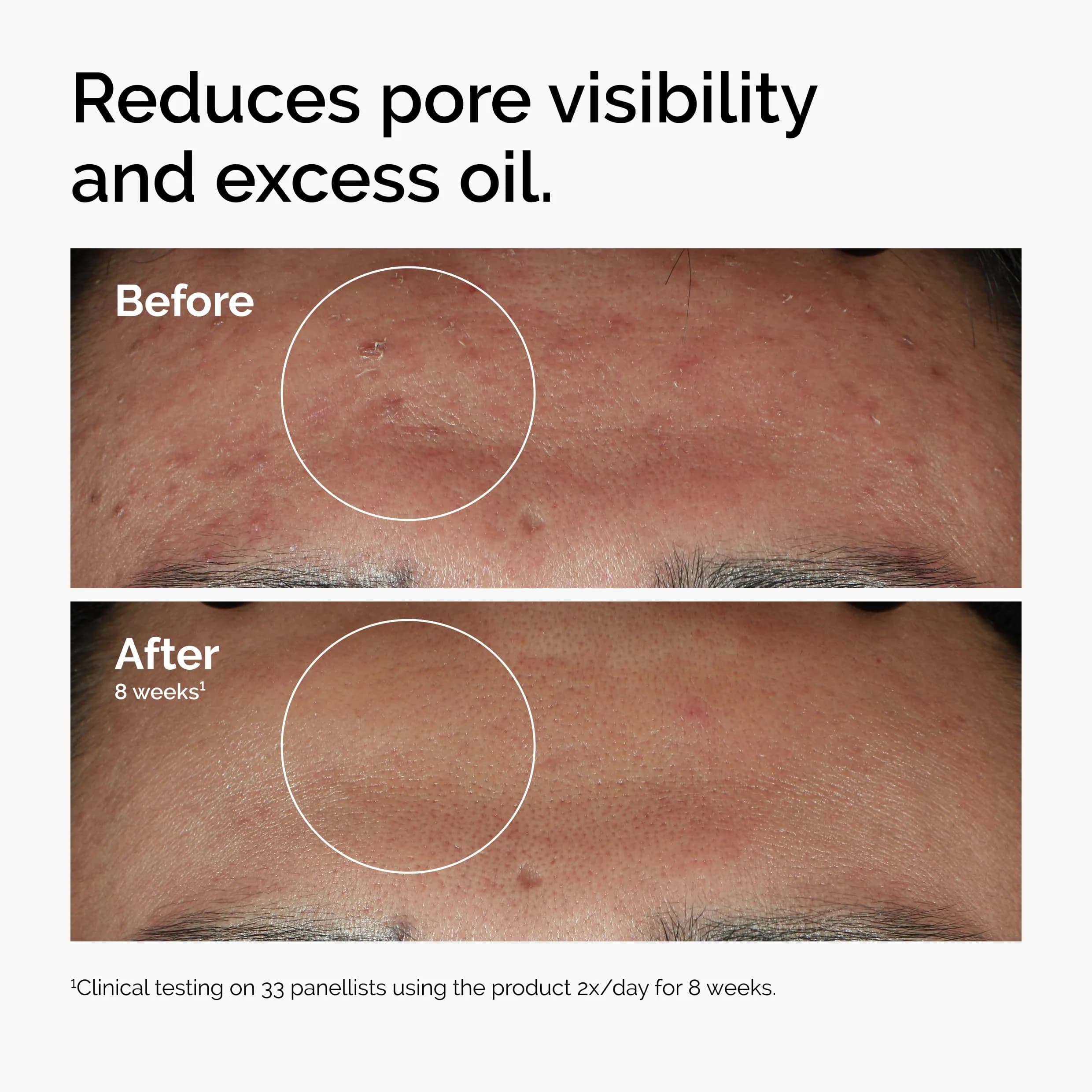 The Ordinary Niacinamide 10% + Zinc 1% Serum (1 Fl Oz / 30ml) - Smoothing Serum for Blemish-Prone Skin - view 2
