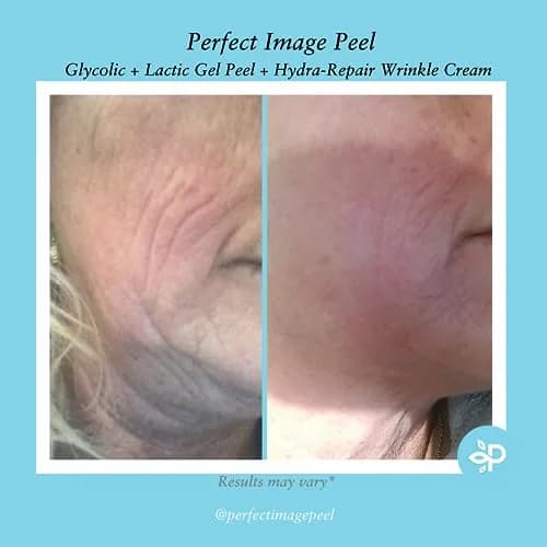 Perfect Image Glycolic Gel Peel 10% Strength | Exfoliating & Hydrating Skin Treatment thumbnail 5