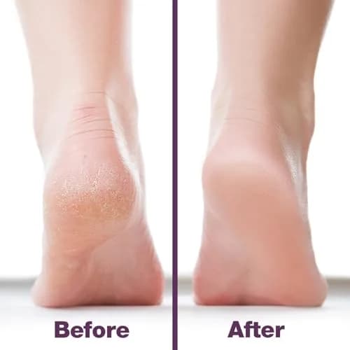 Probelle Double Sided Nickel Foot File Callus Remover, Purple | Safe, Hypoallergenic Pedicure Tool for Dry Feet thumbnail 4