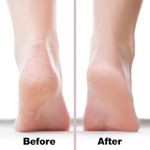 Probelle Double Sided Nickel Foot File Callus Remover, Pink | Safe, Hypoallergenic Pedicure Tool for Soft Feet thumbnail 4