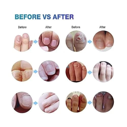 Ariella Toenail Fungus Treatment Extra Strength 12ml | Fungal Nail Repair Pen 4 Pack thumbnail 4