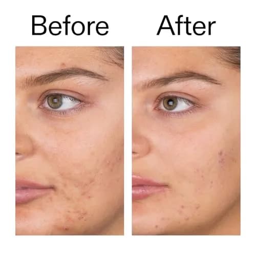 The INKEY List Salicylic Acid Cleanser 5 fl oz | Oil-Control, Blackhead & Breakout Reduction for All Skin Types thumbnail 7