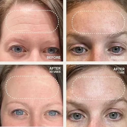 Dermaclara Silicone Patch Eyes & Forehead Kit | Reusable Overnight Wrinkle Pads for Frown & Smile Lines (1 Kit) thumbnail 5