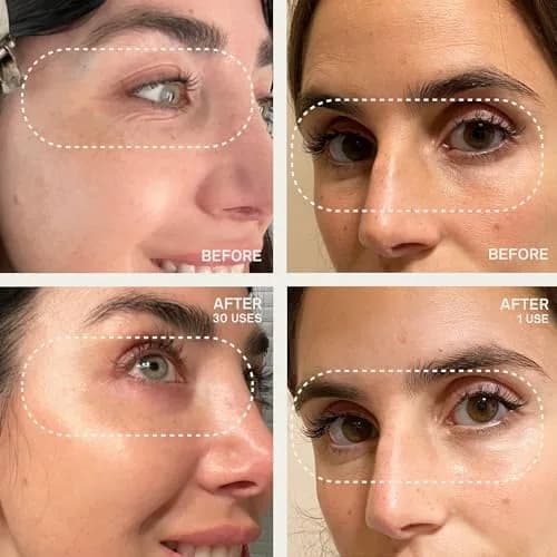 Dermaclara Silicone Patch Eyes & Forehead Kit | Reusable Overnight Wrinkle Pads for Frown & Smile Lines (1 Kit) thumbnail 3