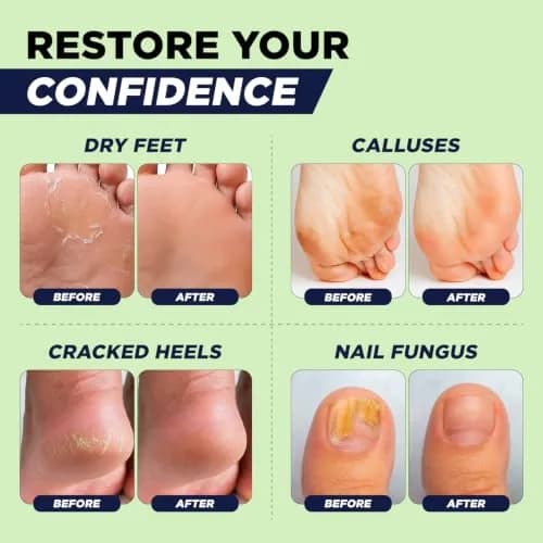 FOOT CURE Tea Tree Oil Epsom Salt Foot Soak 473ml (16 Fl Oz) | Softens Calluses & Refreshes Tired Feet thumbnail 5