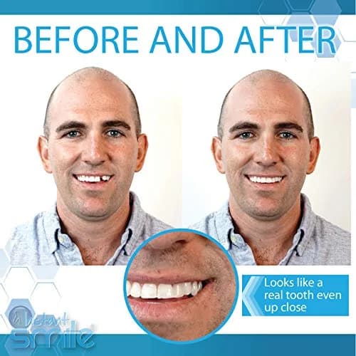 Instant Smile Complete Your Smile Temporary Tooth Replacement Kit - Replace a Missing Tooth in Minutes - Patented thumbnail 5