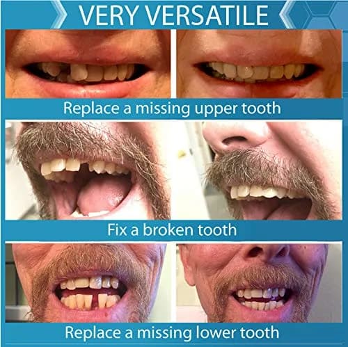 Instant Smile Complete Your Smile Temporary Tooth Replacement Kit - Replace a Missing Tooth in Minutes - Patented thumbnail 6