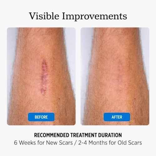NUVADERMIS Silicone Scar Sheets for Surgical & Old Scars | Hydrating, Comfortable & Dermatologist Tested thumbnail 5