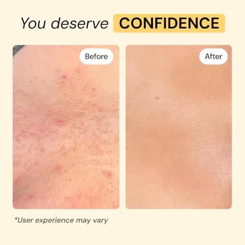 MyMagicHealer Universal Flare Care Drawing Salve 118 ml (4 oz) | For Skin Flare-Ups, Boils, Cysts & Irritated Skin thumbnail 5