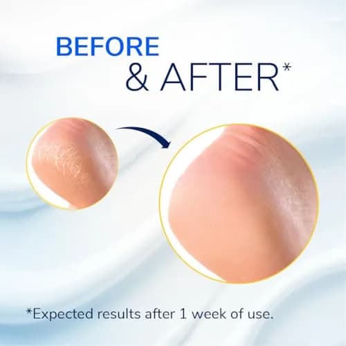 Dr. Scholl's Severe Cracked Heel Repair Balm 2.5oz | 25% Urea for Dry, Cracked Feet thumbnail 3