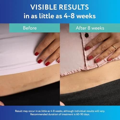 ScarAway Advanced Clear Silicone Scar Sheets, 6 Sheets | Visibly Improve Old & New Scars thumbnail 4