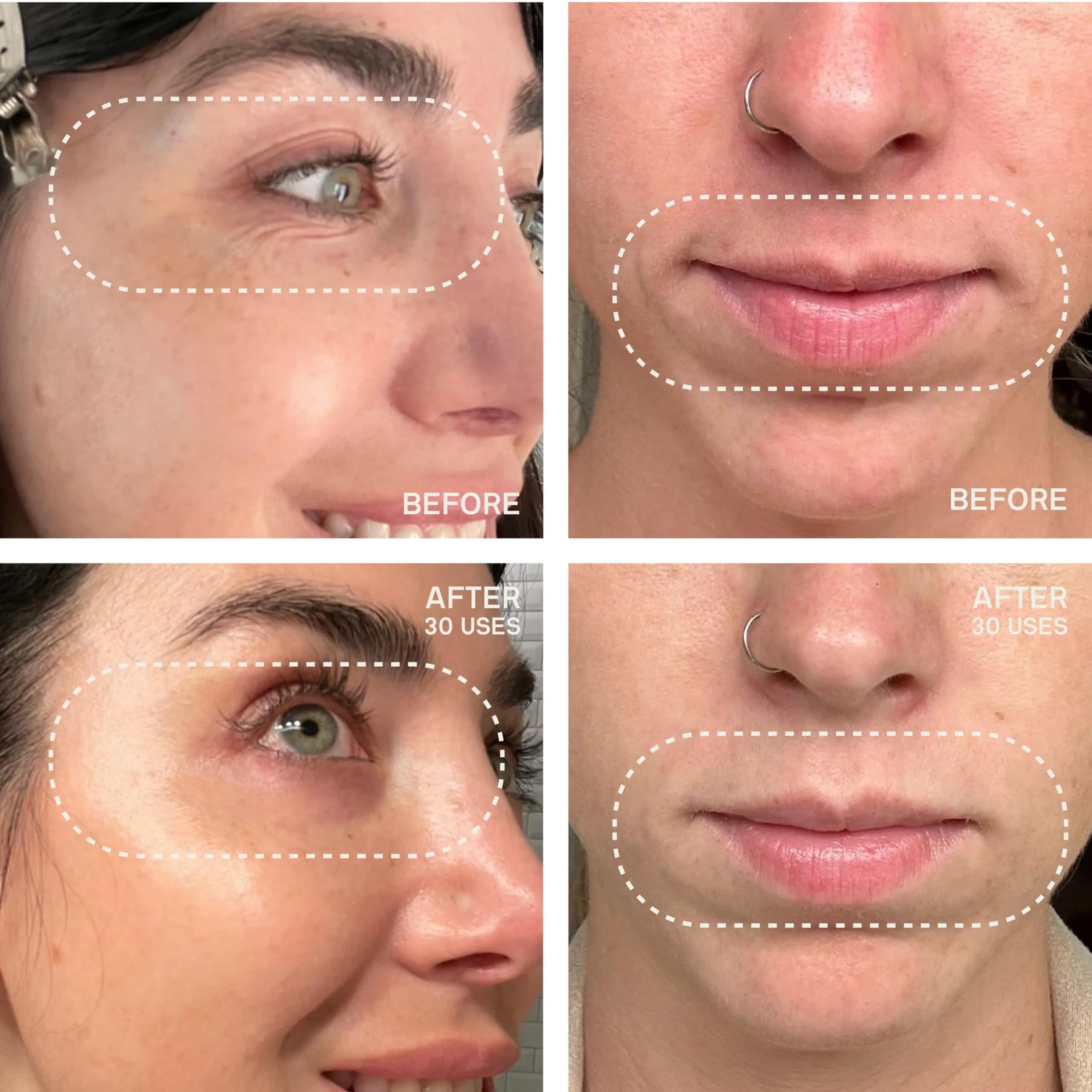 Dermaclara Eye & Mouth Patches | Reusable Silicone Anti-Wrinkle Pads for Smile Lines & Under Eye, 4 Count - view 3