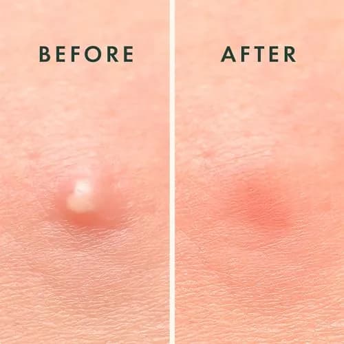 Rael Hydrocolloid Acne Pimple Patches 52 Ct | Overnight Spot Cover for All Skin Types thumbnail 7