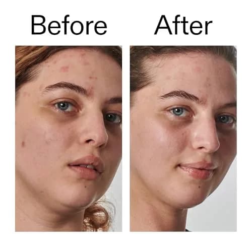 The INKEY List SuperSolutions Urea 10% Moisturizer 50ml | Fast Absorbing, Hydrates & Exfoliates Very Dry Skin thumbnail 7