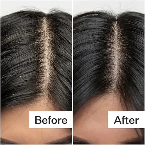 ACT+ ACRE Salicylic Acid Scalp Exfoliator 2 fl oz | Gentle Oil & Flake Removal for Oily Scalp thumbnail 5