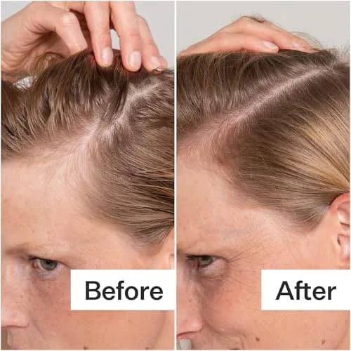 ACT+ ACRE Salicylic Acid Scalp Exfoliator 2 fl oz | Gentle Oil & Flake Removal for Oily Scalp thumbnail 3