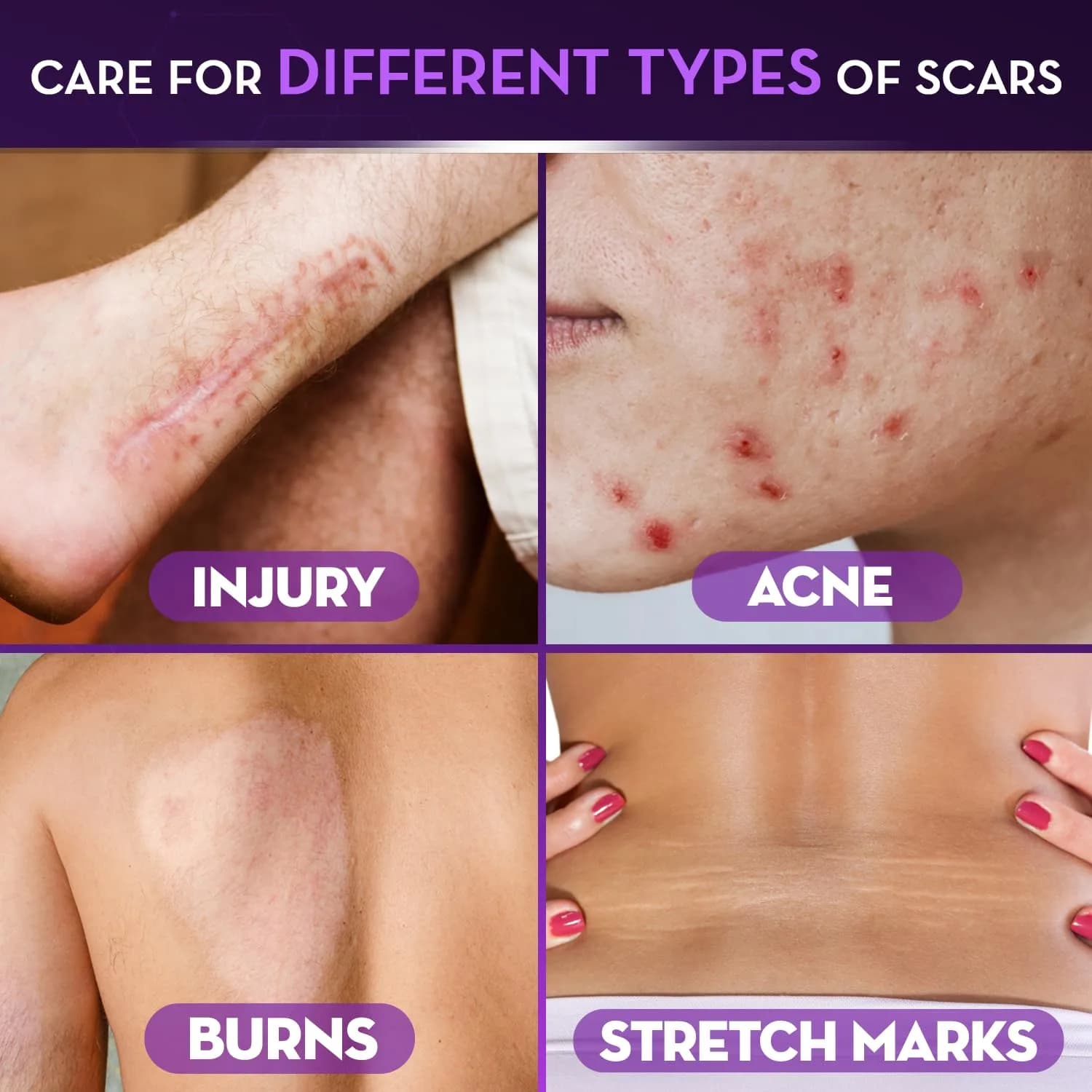 Cicatricure Advanced Face & Body Scar Gel, 1oz (28g) - Clinically Proven Treatment - view 4