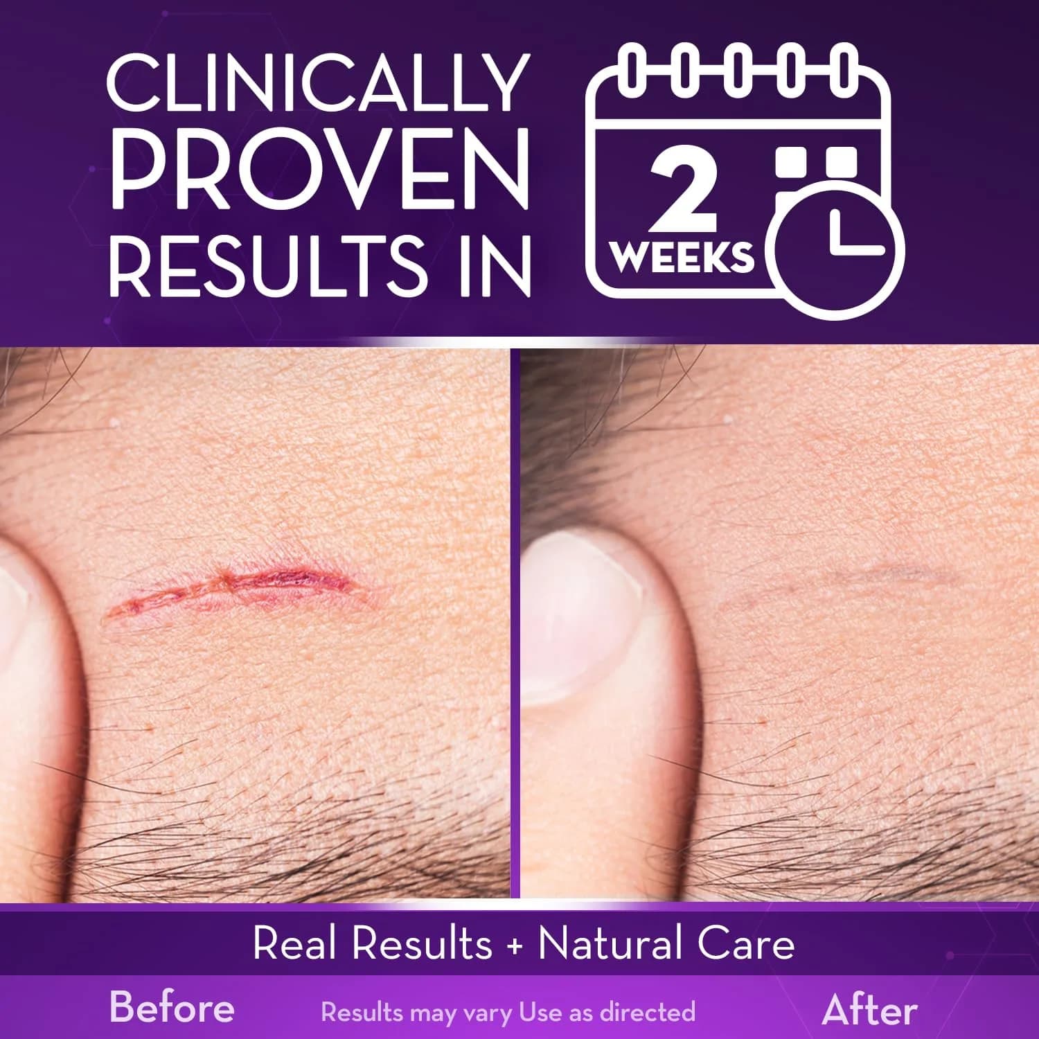 Cicatricure Advanced Face & Body Scar Gel, 1oz (28g) - Clinically Proven Treatment - view 3