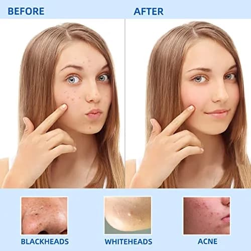 yuntop Blackhead Remover Tool Kit 5 Pack Stainless Steel | Professional Face Nose Extractor (70-120 chars) thumbnail 7