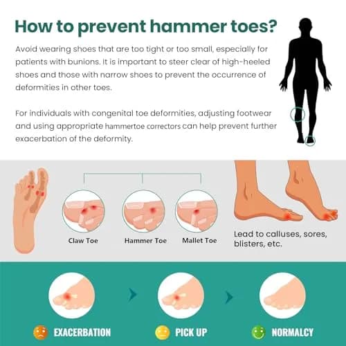 Welnove Hammertoe Corrector - 6 Pack Toe Splints - Soft Gel Toe Straighteners - Realign Bent, Curled, Crooked, Claw, Hammer Toes - Corrector for Men and Women, Large (Beige), FSA or HSA Eligible thumbnail 7