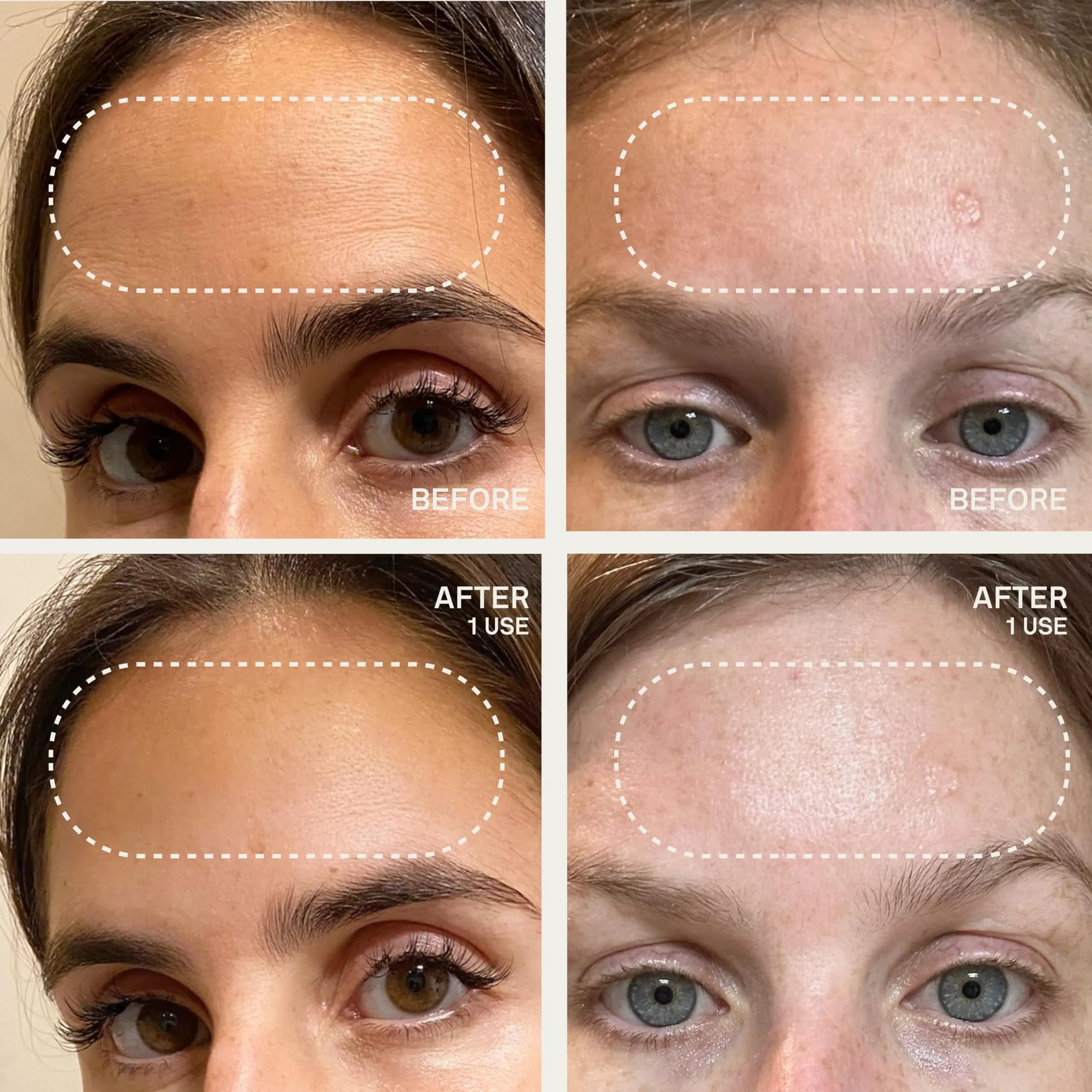 Dermaclara Forehead Patch - Reusable Silicone Wrinkle Patches for Face Overnight | 1 Count - view 5