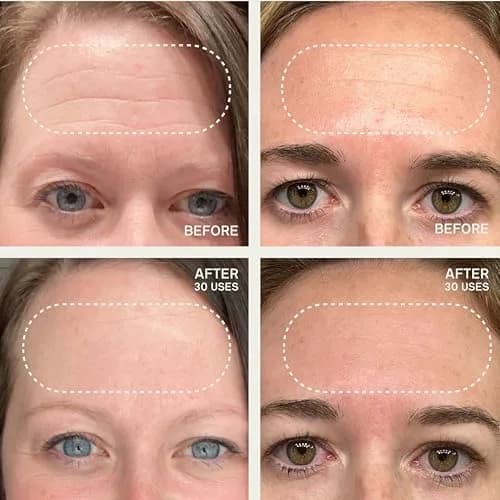 Dermaclara Forehead Patch - Reusable Silicone Wrinkle Patches for Face Overnight | 1 Count thumbnail 3