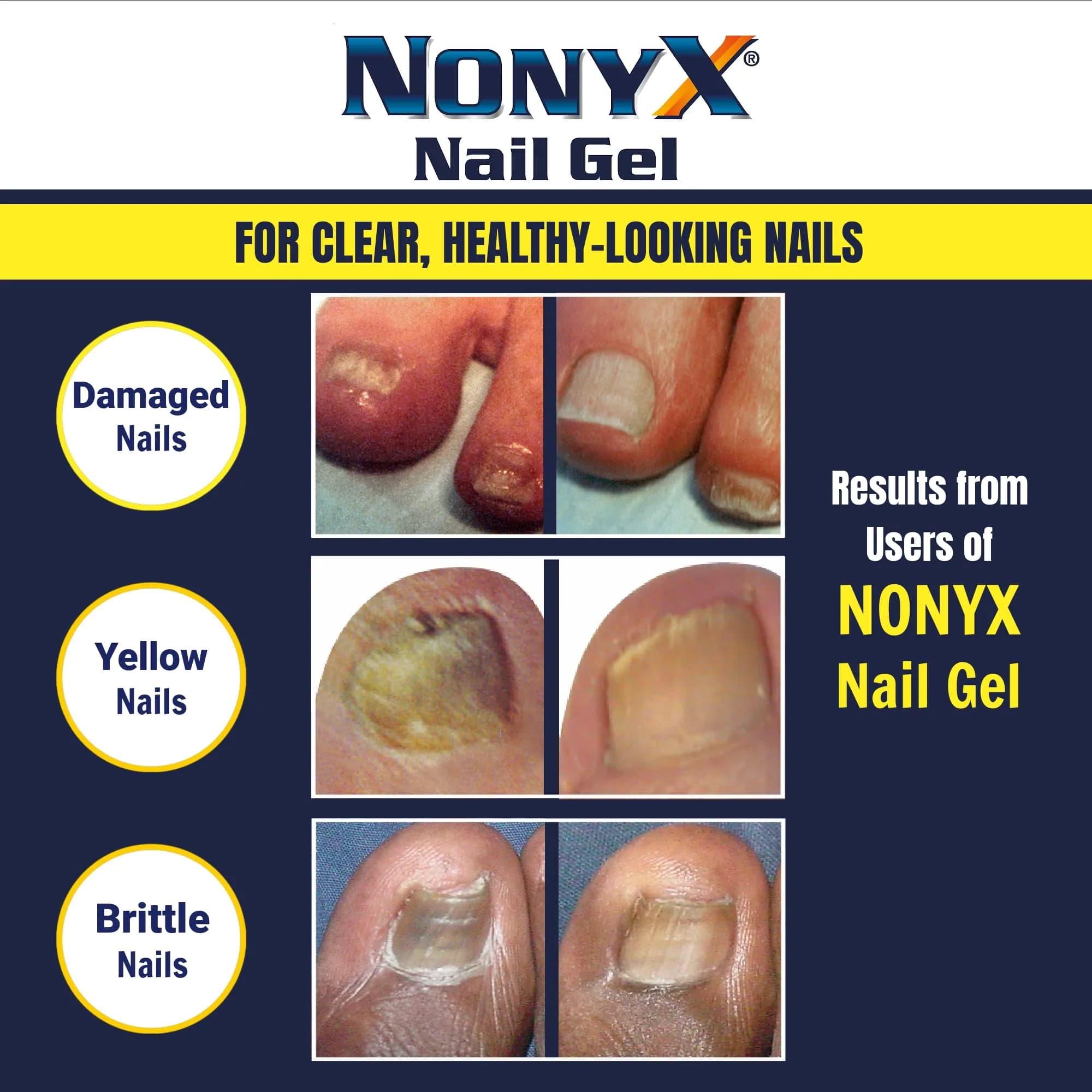 NONYX Fungal Nail Clarifying Gel (8 Fl Oz / 237ml) | Clinically Proven for Discolored, Thick, Brittle, Yellow, Lifted Nails - view 5