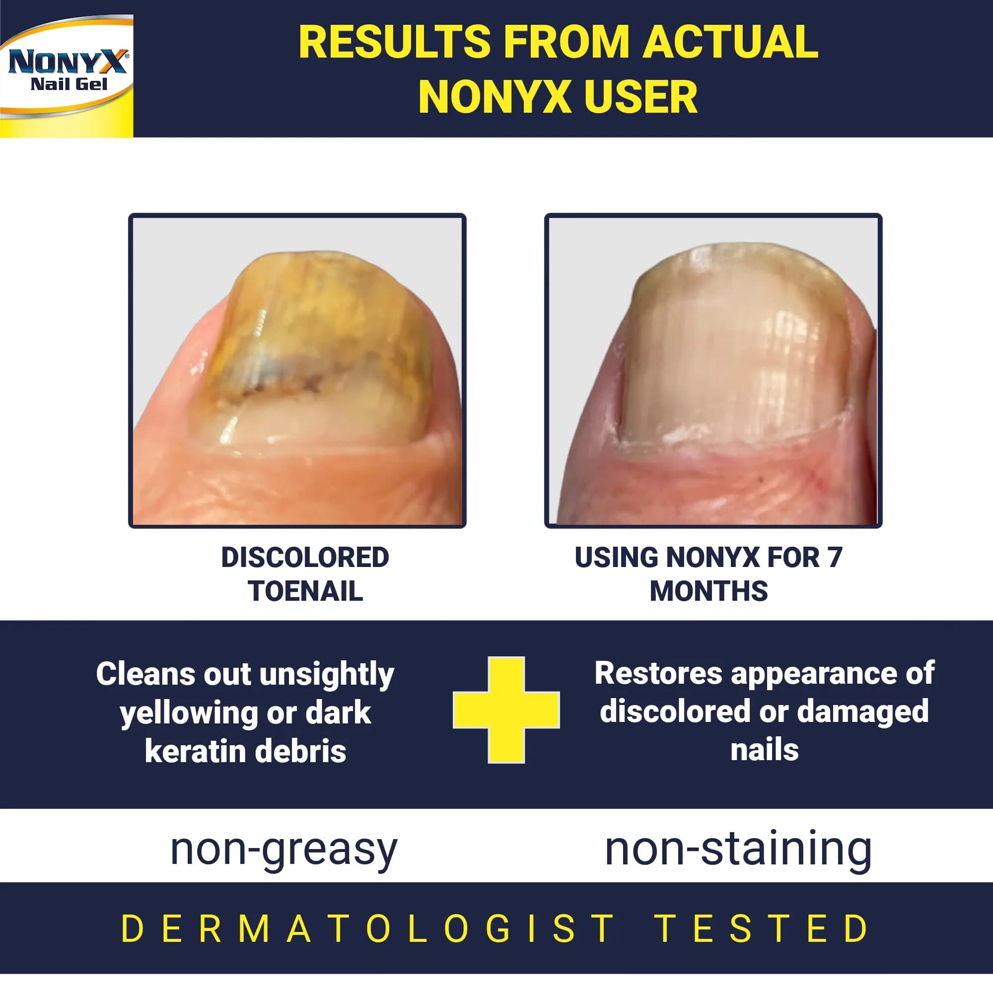 NONYX Fungal Nail Clarifying Gel (8 Fl Oz / 237ml) | Clinically Proven for Discolored, Thick, Brittle, Yellow, Lifted Nails - view 2