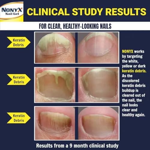 NONYX Fungal Nail Clarifying Gel (8 Fl Oz / 237ml) | Clinically Proven for Discolored, Thick, Brittle, Yellow, Lifted Nails thumbnail 3
