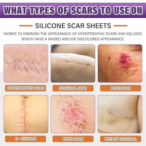 PSECICI Silicone Scar Sheets 1.5m (59") Beige | Medical Grade Scar Tape for Old & New Scars thumbnail 2